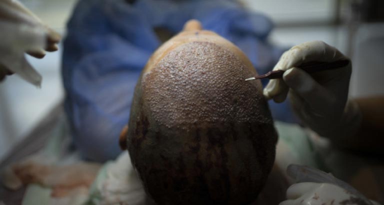 Dr Mukesh Jivanprakash Batra Hair Transplant Surgeon Middle East Hospital Bahrain